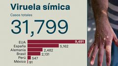 Casos mundiales de viruela del mono ascienden...